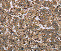 Immunohistochemistry of paraffin-embedded Human liver cancer tissue using IKBIP Polyclonal Antibody at dilution 1:30