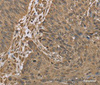 Immunohistochemistry of paraffin-embedded Human lung cancer tissue using IKBIP Polyclonal Antibody at dilution 1:30