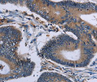 Immunohistochemistry of paraffin-embedded Human colon cancer using IPO4 Polyclonal Antibody at dilution of 1:50