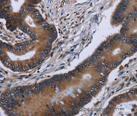 Immunohistochemistry of paraffin-embedded Human colon cancer tissue using ITGAE Polyclonal Antibody at dilution of 1:60
