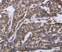 Immunohistochemistry of paraffin-embedded Human breast cancer tissue using DDX11 Polyclonal Antibody at dilution 1:30