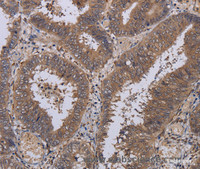 Immunohistochemistry of paraffin-embedded Human colon cancer tissue using P3H3 Polyclonal Antibody at dilution 1:40