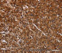 Immunohistochemistry of paraffin-embedded Human prostate cancer using ACP6 Polyclonal Antibody at dilution of 1:30