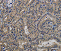 Immunohistochemistry of paraffin-embedded Human thyroid cancer tissue using TAB1 Polyclonal Antibody at dilution 1:40