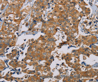 Immunohistochemistry of paraffin-embedded Human thyroid cancer using TAB3 Polyclonal Antibody at dilution of 1:35