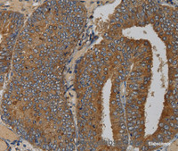 Immunohistochemistry of paraffin-embedded Human colon cancer tissue using MAS1 Polyclonal Antibody at dilution 1:50