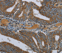 Immunohistochemistry of paraffin-embedded Human colon cancer using PCK2 Polyclonal Antibody at dilution of 1:60