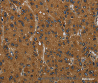 Immunohistochemistry of paraffin-embedded Human liver cancer tissue using MIER2 Polyclonal Antibody at dilution 1:60