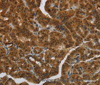 Immunohistochemistry of paraffin-embedded Human thyroid cancer tissue using MRE11 Polyclonal Antibody at dilution 1:60