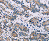 Immunohistochemistry of paraffin-embedded Human colon cancer using ODF2 Polyclonal Antibody at dilution of 1:30