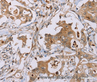 Immunohistochemistry of paraffin-embedded Human colon cancer using OTC Polyclonal Antibody at dilution of 1:40