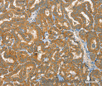 Immunohistochemistry of paraffin-embedded Human thyroid cancer tissue using RAB25 Polyclonal Antibody at dilution 1:40