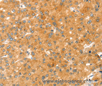 Immunohistochemistry of paraffin-embedded Human liver cancer using RAB27A Polyclonal Antibody at dilution of 1:30