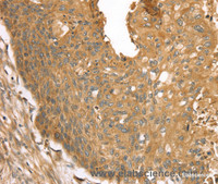 Immunohistochemistry of paraffin-embedded Human esophagus cancer using STX16 Polyclonal Antibody at dilution of 1:30