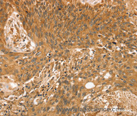 Immunohistochemistry of paraffin-embedded Human esophagus cancer using STX10 Polyclonal Antibody at dilution of 1:35