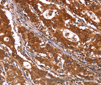 Immunohistochemistry of paraffin-embedded Human gastric cancer using ABI1 Polyclonal Antibody at dilution of 1:40