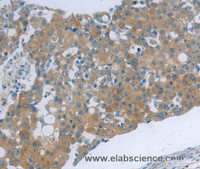 Immunohistochemistry of paraffin-embedded Human ovarian cancer tissue using TNK2 Polyclonal Antibody at dilution 1:70