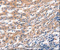 Immunohistochemistry of paraffin-embedded Human liver cancer using RAB18 Polyclonal Antibody at dilution of 1:300