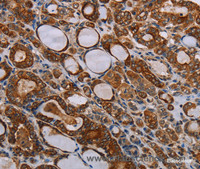 Immunohistochemistry of paraffin-embedded Human thyroid cancer tissue using FABP3 Polyclonal Antibody at dilution 1:40