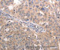 Immunohistochemistry of paraffin-embedded Human lung cancer using BGLAP Polyclonal Antibody at dilution of 1:60