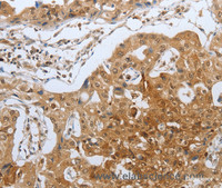 Immunohistochemistry of paraffin-embedded Human lung cancer using CASP12 Polyclonal Antibody at dilution of 1:50