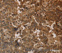 Immunohistochemistry of paraffin-embedded Human liver cancer using CK-16 Polyclonal Antibody at dilution of 1:30