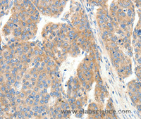 Immunohistochemistry of paraffin-embedded Human ovarian cancer tissue using COL4A1 Polyclonal Antibody at dilution 1:30