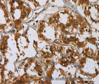 Immunohistochemistry of paraffin-embedded Human thyroid cancer tissue using GATA5 Polyclonal Antibody at dilution 1:50