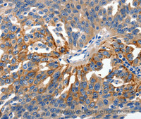 Immunohistochemistry of paraffin-embedded Human ovarian cancer using Claudin 1 Polyclonal Antibody at dilution of 1:150