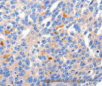 Immunohistochemistry of paraffin-embedded Human liver cancer tissue using KCNH8 Polyclonal Antibody at dilution 1:50