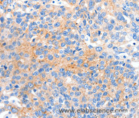 Immunohistochemistry of paraffin-embedded Human ovarian cancer tissue using HCN2 Polyclonal Antibody at dilution 1:80