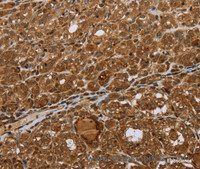 Immunohistochemistry of paraffin-embedded Human thyroid cancer using STMN2/3/4 Polyclonal Antibody at dilution of 1:45