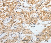 Immunohistochemistry of paraffin-embedded Human liver cancer tissue using BPIFB2 Polyclonal Antibody at dilution 1:45