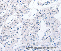 Immunohistochemistry of paraffin-embedded Human lung cancer using POMC Polyclonal Antibody at dilution of 1:30