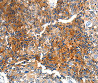 Immunohistochemistry of paraffin-embedded Human breast cancer using MTNR1A Polyclonal Antibody at dilution of 1:100