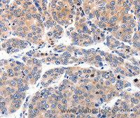 Immunohistochemistry of paraffin-embedded Human liver cancer using MYL9 Polyclonal Antibody at dilution of 1:80