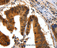 Immunohistochemistry of paraffin-embedded Human colon cancer using 14-3-3 beta/alpha Polyclonal Antibody at dilution of 1:30