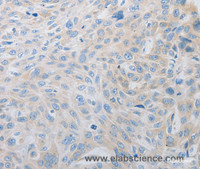 Immunohistochemistry of paraffin-embedded Human esophagus cancer using PDX1 Polyclonal Antibody at dilution of 1:30