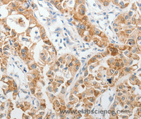 Immunohistochemistry of paraffin-embedded Human lung cancer tissue using PIBF1 Polyclonal Antibody at dilution 1:60