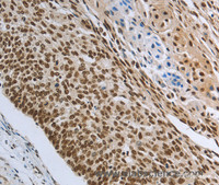 Immunohistochemistry of paraffin-embedded Human cervical cancer tissue using PRMT3 Polyclonal Antibody at dilution 1:30