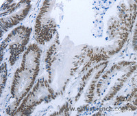 Immunohistochemistry of paraffin-embedded Human colon cancer tissue using RBMS1 Polyclonal Antibody at dilution 1:30