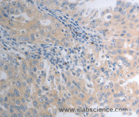 Immunohistochemistry of paraffin-embedded Human ovarian cancer tissue using SHH Polyclonal Antibody at dilution 1:40