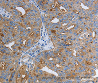 Immunohistochemistry of paraffin-embedded Human ovarian cancer using SLC34A2 Polyclonal Antibody at dilution of 1:50