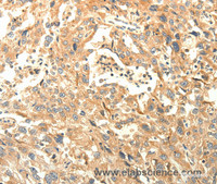 Immunohistochemistry of paraffin-embedded Human esophagus cancer tissue using AGRN Polyclonal Antibody at dilution of 1:30