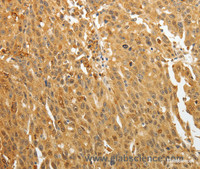 Immunohistochemistry of paraffin-embedded Human ovarian cancer using AKR1A1 Polyclonal Antibody at dilution of 1:30