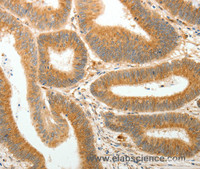 Immunohistochemistry of paraffin-embedded Human colon cancer using AKR1B1 Polyclonal Antibody at dilution of 1:30