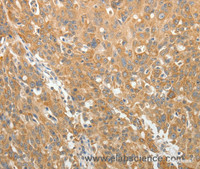 Immunohistochemistry of paraffin-embedded Human ovarian cancer using AKR1B1 Polyclonal Antibody at dilution of 1:30