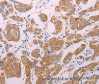 Immunohistochemistry of paraffin-embedded Human breast cancer using AGT Polyclonal Antibody at dilution of 1:30