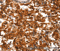 Immunohistochemistry of paraffin-embedded Human thyroid cancer tissue using BCAS3 Polyclonal Antibody at dilution 1:40