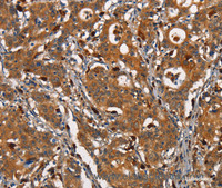 Immunohistochemistry of paraffin-embedded Human gastric cancer tissue using CEACAM3 Polyclonal Antibody at dilution 1:30